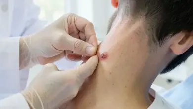 Jak odstranit fibromy bezpečně a efektivně - ilustrační foto