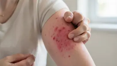 Jak rozpoznat a léčit alergickou kontaktní dermatitidu - ilustrační foto