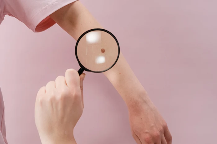 Lupa na ruce s pihou pro kontrolu melanomu