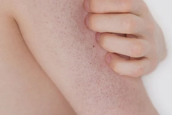 Blízký záběr na kůži s keratózou pilorickou.