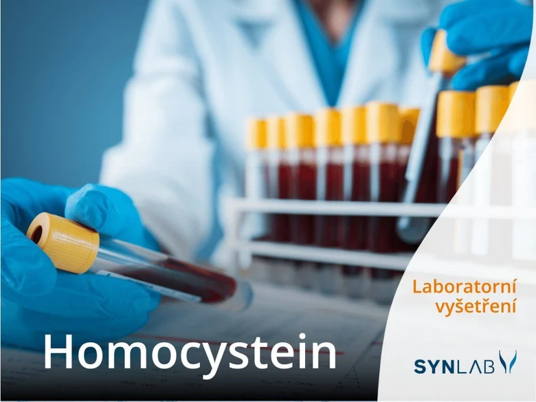 Laboratorní testování hladiny homocysteinu v krvi.