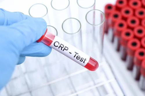 Ruka drží zkumavku s krví označenou CRP pro krevní test.