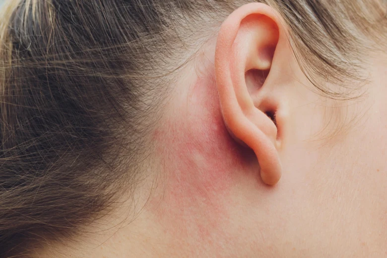 Zapálená kůže za uchem při alergické kontaktní dermatitidě.