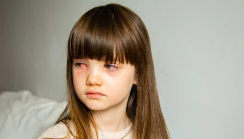 Dívka s červenýma očima ukazující příznaky zánětu spojivek.