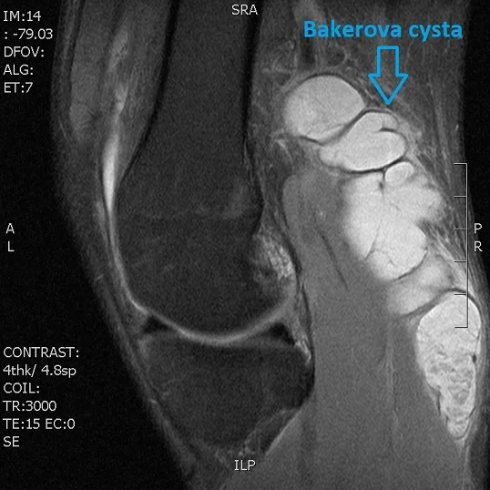 Magnetická rezonance kolene ukazující Bakerovu cystu v zadní části.