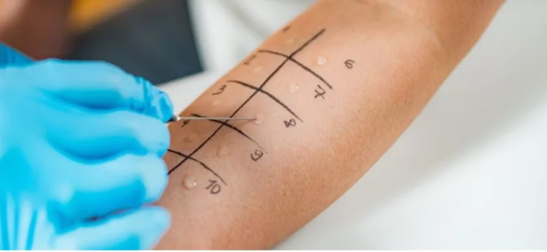 Kožní kožní test pro diagnostiku alergií na předloktí.