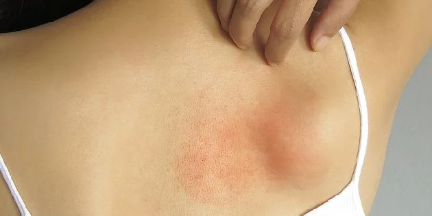 Red skin rash on back