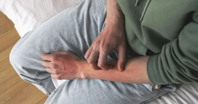 Muž škrábe červené vyrážky na předloktí.