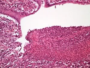 Histologický snímek zánětlivého střeva u Crohnovy choroby