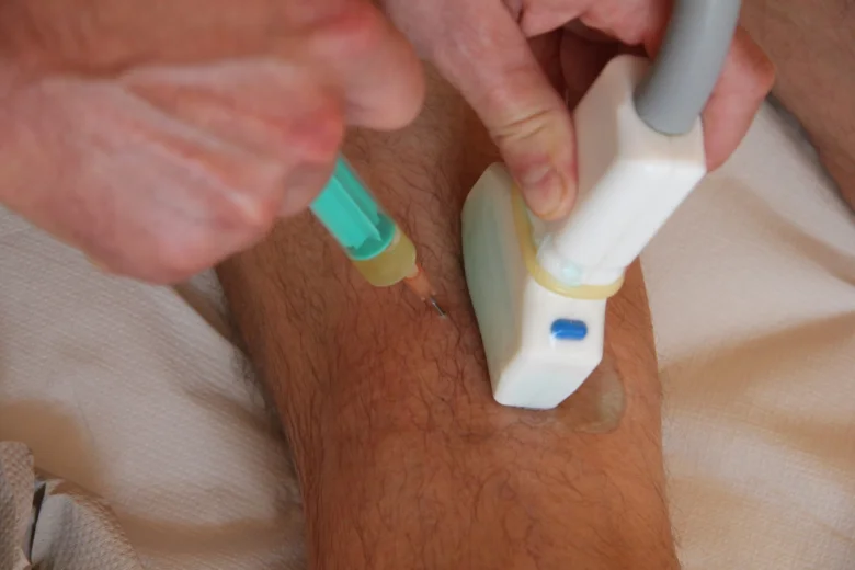 Ultrazvukem řízená aspirace nebo injekce do nohy při léčbě Bakerovy cysty.