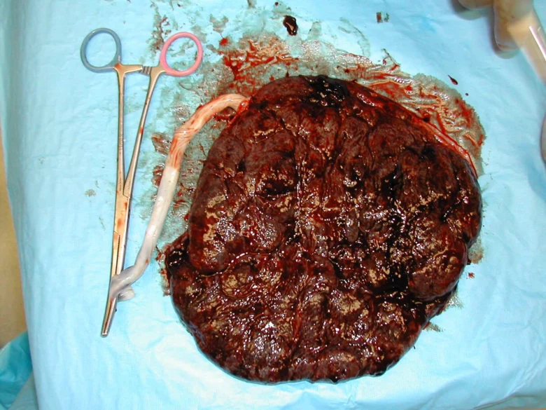 Placenta s pupečníkem po porodu na modrém prostěradle.
