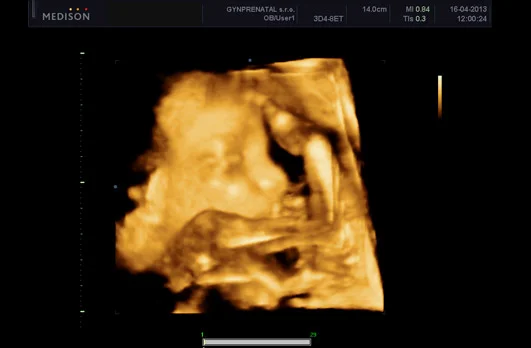 3d ultrasound fetus scan