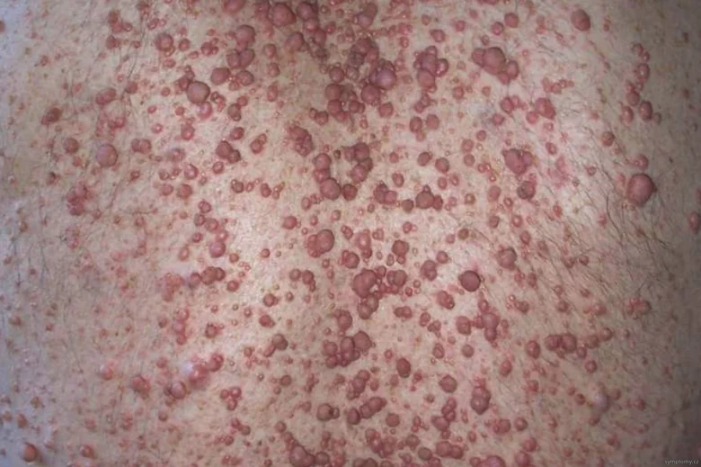Kožní neurofibromy na kůži jako příznak neurofibromatózy.