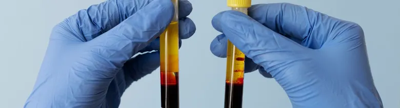 Ruce v rukavicích drží zkumavky s krví obsahujícími hemoglobin.