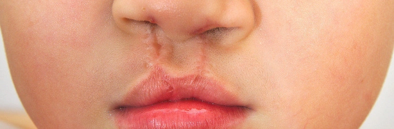 Cleft lip and palate