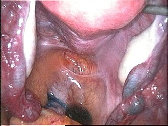 Vnitřní pohled na ženské pánve během gynekologické laparoskopie.