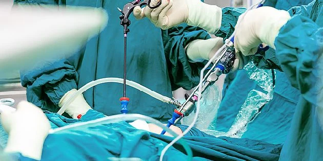 Laparoskopický zákrok s nástroji v břišní dutině během operace.